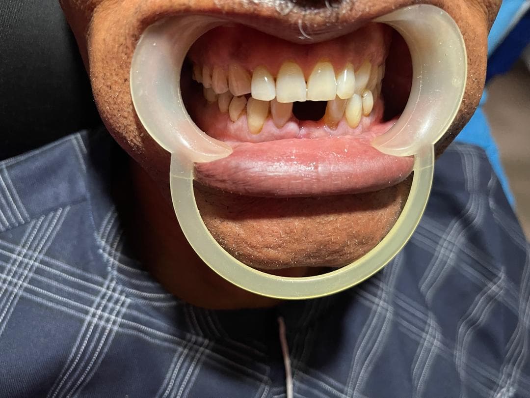 Before Treatment